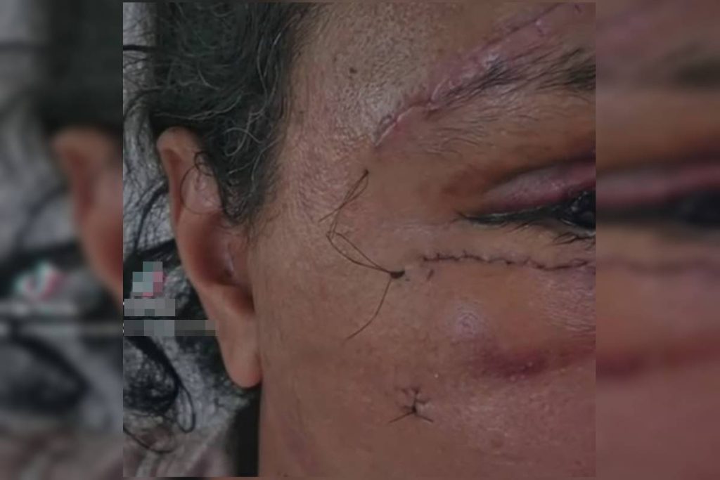 mulher-que-levou-61-socos-mostra-rosto-em-recuperacao:-“mao-de-deus”