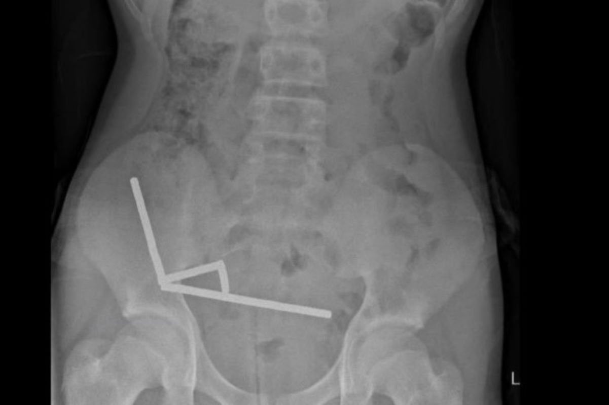 adolescente-engole-mais-de-80-imas-e-perde-parte-do-intestino adolescente-engole-mais-de-80-imas-e-perde-parte-do-intestino