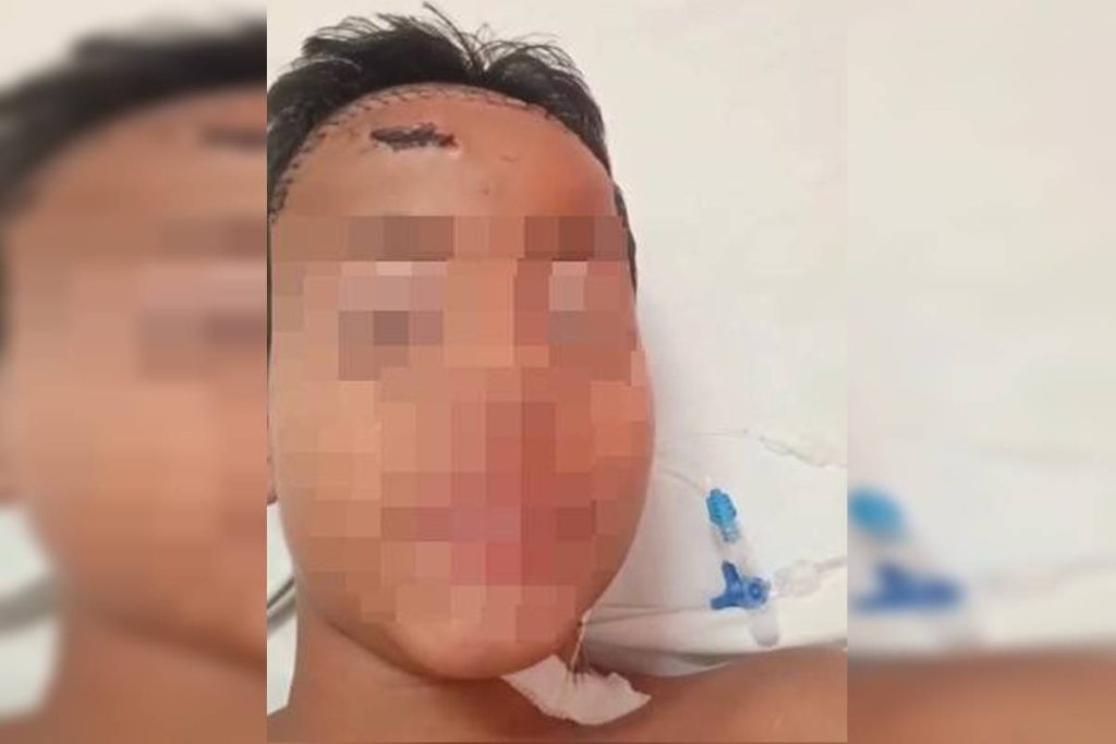 menino-de-11-anos-espancado-por-gangue-no-lugar-do-irmao-recebe-alta